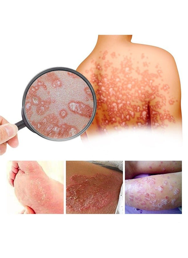 South Moon - Bee Venom Psoriasis Care Cream (Original)