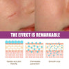 SCAR REMOVAL CREAM