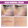 SCAR REMOVAL CREAM